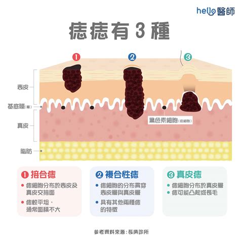 痣 生成原因